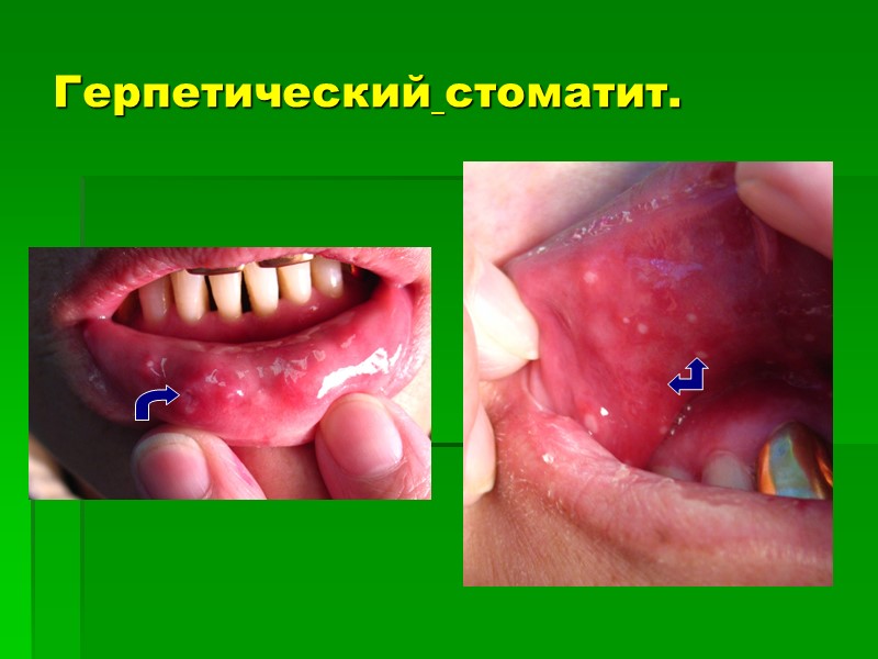 Герпетический стоматит.